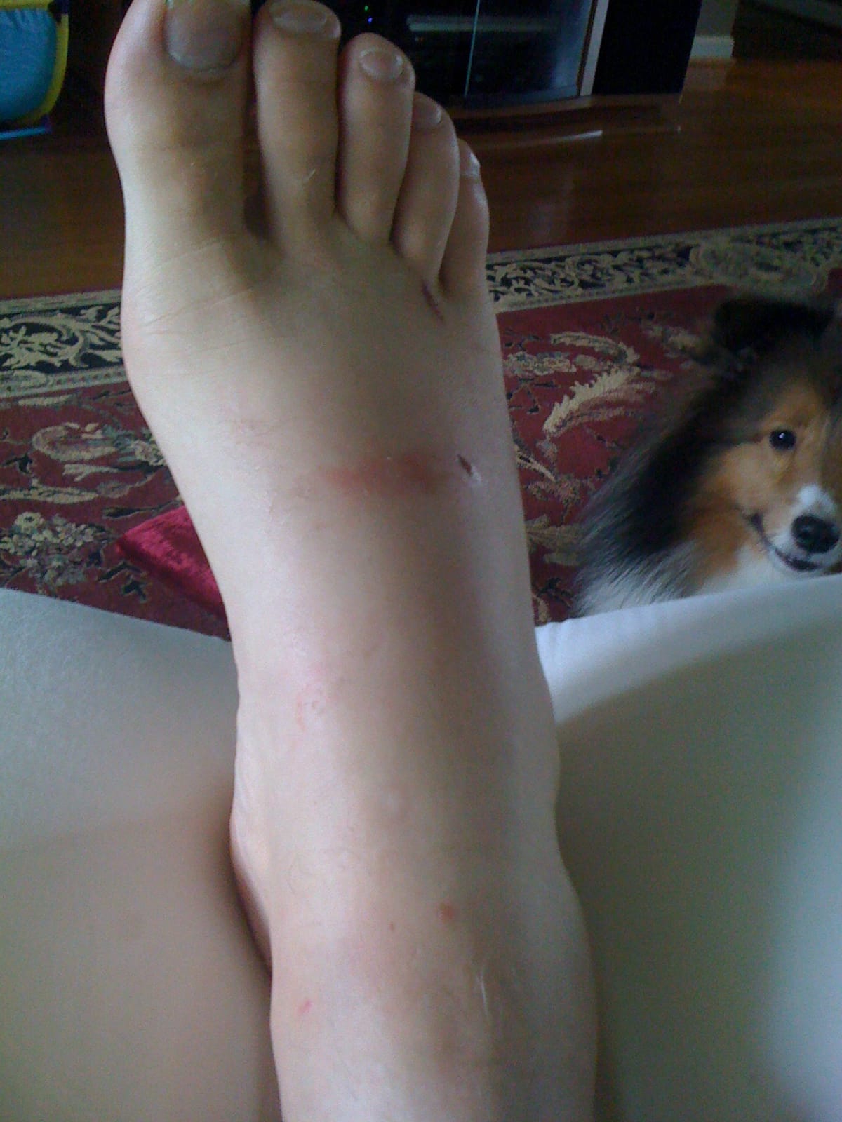 Smashed Foot 1