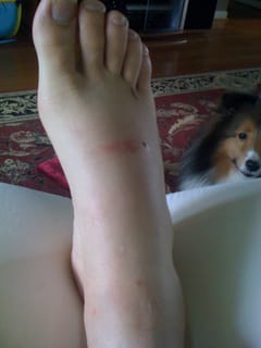 Smashed Foot 1