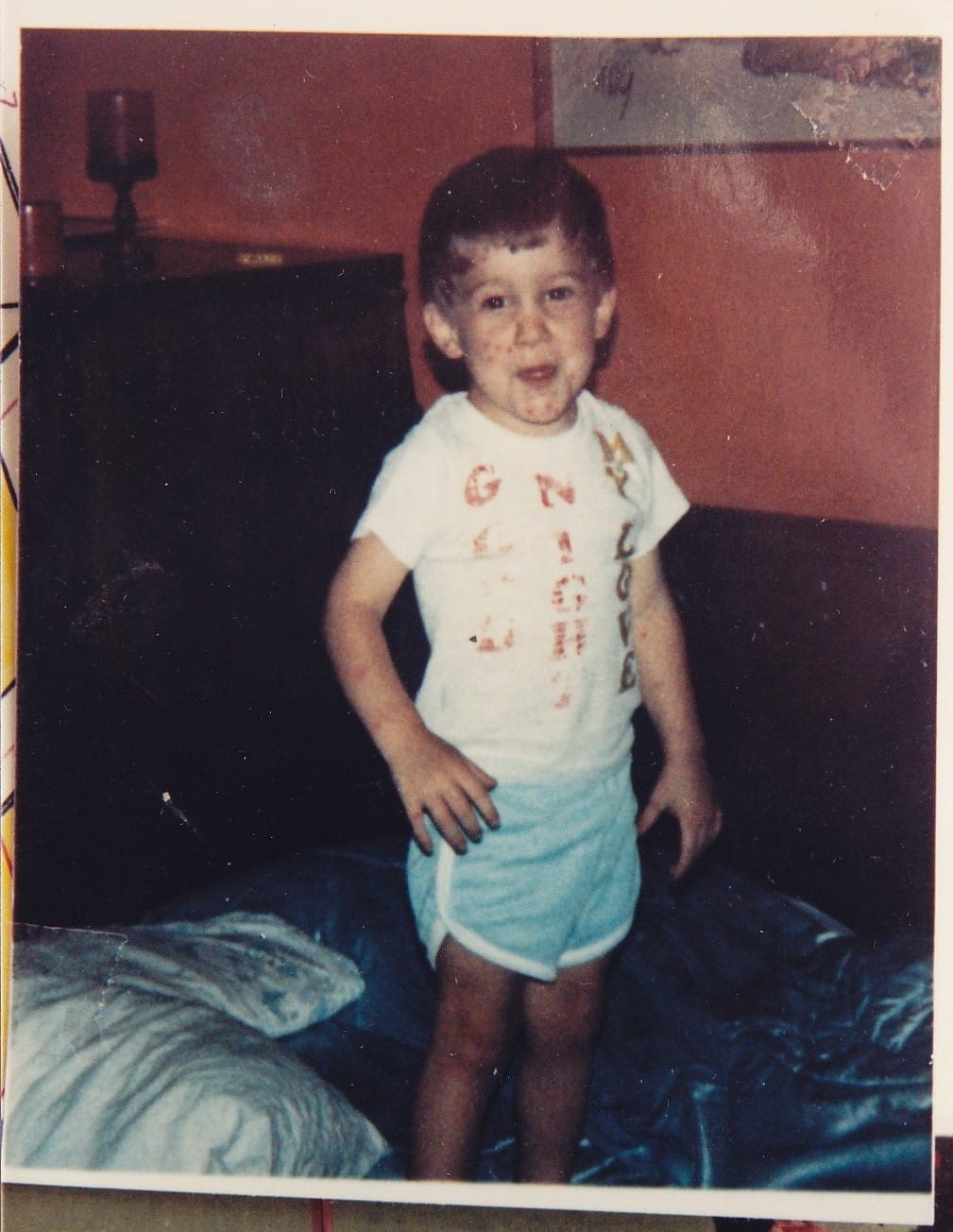 Chicken Pox!